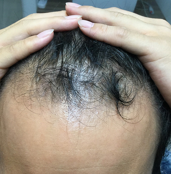 AGA（男性型脱毛）の治療 施術前