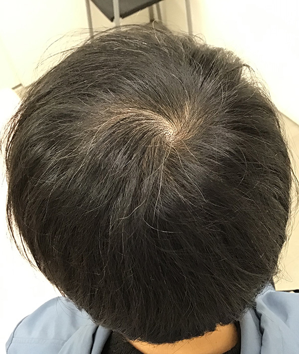 AGA（男性型脱毛）の治療 施術後