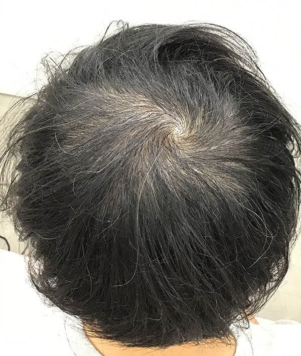 AGA（男性型脱毛）の治療 施術前